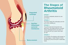 rheumatoid arthritis stages and progression