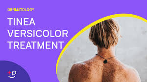 Tinea versicolor is a very common fungal infection of the skin. How To Treat Tinea Versicolor Youtube