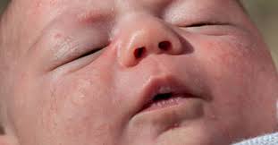 Baby Milia Treatment: 3 Safe Tips Paano Ito Matatanggal