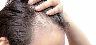 In questa patologia la perdita dei capelli è localizzata alle aree in cui i. Alopecia Da Stress Come Curarla Tricopigmentazione Org