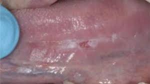 Image result for dental cancer