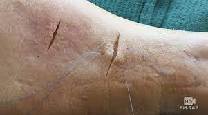 Maybe you would like to learn more about one of these? Hd Horizontal Mattress Suture Em Rap