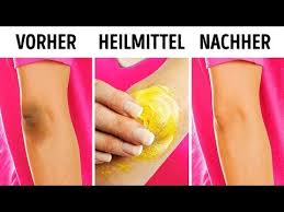Doch ideal wirkt das mittel nicht. 10 Naturliche Tricks Wie Man Dunkle Knie Und Ellbogen Loswird Youtube