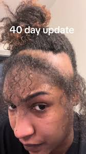 #hairloss #baldspot #haircare #hairgrowth #hairlossjourney #hairrestoration  #scalptreatment