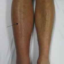 Maybe you would like to learn more about one of these? Conoce Los Efectos Y Sintomas De La Tvp Trombosis Venosa Profunda
