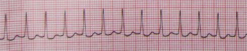 Paroxysmal means from time to time. Ecg Interpretation Of Arrhythmias Tusom Pharmwiki