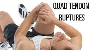 A sign of a torn calf muscle is similar to that of an achilles tendon rupture. Quadriceps Tendon Tear Physiopedia