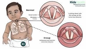 Image result for Croup