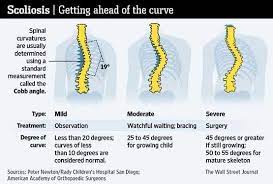What Is Scoliosis Can It Be Compared With Other Disease Scoliosis Scoliosis Exercises Posture Fix