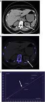 Image result for Nephrolithiasis Imaging