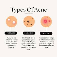 Image result for Pustule