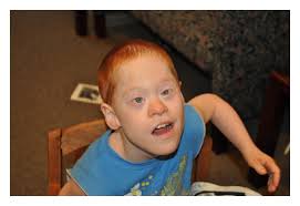 Figure 1 A Male With Cooccurrence Of Down Syndrome And Fragile X Syndrome