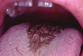 Image result for black hairy tongue symptoms