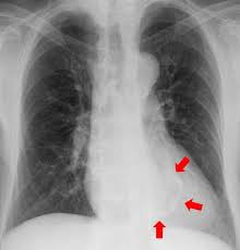 Die fälle sind indes selten. Kardiologie Rontgen Thorax Thorax Ct Kardio Ct Kardio Mr