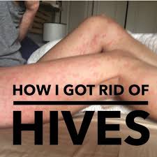 Hives And Gut Infections This Past Winter I Was Suffering From Severe Hive Breakouts I Had Hives Everyday Home Remedies For Hives Hives Remedies Chronic Hives