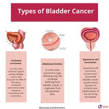 Image result for Bladder Cancer Staging