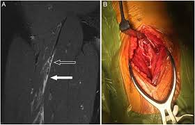 Serious Thigh Muscle Strains Beware The Intramuscular Tendon Which Plays An Important Role In Difficult Hamstring And Quadriceps Muscle Strains British Journal Of Sports Medicine