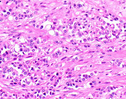 A mesothelioma law firm specializes in asbestos law and mesothelioma cases. Pathology Outlines Diffuse Malignant Mesothelioma