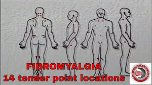 fibromyalgia screening for the 14 tender points