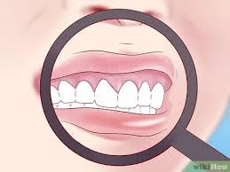 Risk factors for mouth cancer include: How To Tell If You Have Mouth Cancer 15 Steps With Pictures