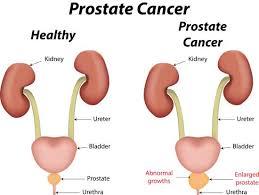 Both prostate cancer and its treatment can cause urinary incontinence. Prostate Cancer Symptoms Causes And Treatment Article1000 Com