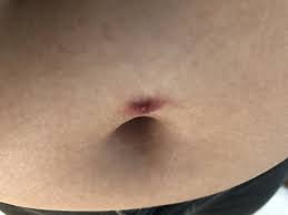 What Is Wrong With My Belly Button Piercing The Skin That The Bar Is Through Is Very Red And Sore Photos
