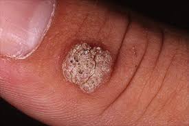 Pictures of warts on fingers. Warts My Doctor Online