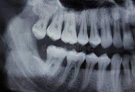 Dental Xray Left Half Full Mouth Panoramic Dental X Ray Of A 29 Year Old Male Aff Mouth Panoramic Dental Ful Dental Dental Life Patient Experience