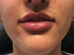 Maybe you would like to learn more about one of these? Lip Filler Spaks Nv Cosmetic Injectables Fillers Before And After Gallery