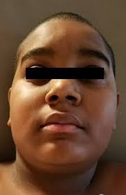 Acute development of Cushing syndrome in an HIV-infected child