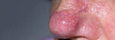 Das rhinophym ist eine hautkrankheit, die nach fortgeschrittener oder unbehandelter rosazea auftritt und eine charakteristische schwellung und rötung der nase verursacht. Personalisierte Therapie Der Rosazea Dank Verschiedener Behandlungsoptionen Medical Tribune
