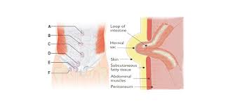 An emergent operation should accordingly be performed based on infection control, oncological principles, and secure hernia repair. Types Of Hernia How Are They Recognized Neoalta Speciality Clinic