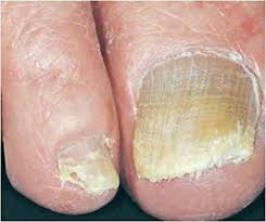 why our toenails thicken as we age