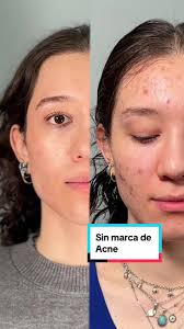 Respuesta a @Kari Bracho sin marcas de acne #skincare #acne #belleza  #rostroperfecto #rostro #quitaracna #cacarizos