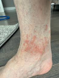 Image result for allergy rash on the legs