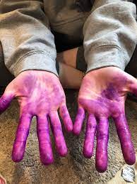 Forget to put on gloves before apply hair dye on hair.can't get rid off when found out later.try everthing, baking soda.soap, detergents.viegar.need i dyed my friend's hair black today, and i didn't wear gloves. So My Friend Has Purple Hands She Used Splat Hair Dye And It Stained Her Hands We Know It Wasn T A Good Idea But How Does She Get It Off Before We