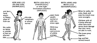 Cerebral palsy meaning & explanation. What Is Cerebral Palsy Nursing Crib