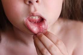 Image result for Canker sores roof of mouth