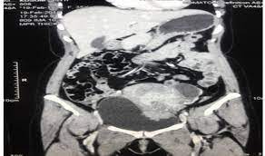 During the scan, the round tube will move and scan your body. Deep Infiltrating Endometriosis Of The Uterus Involving The Urinary Bladder Bmj Case Reports