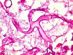 A doença causa a morte em 50% das infecções, sendo necessário submeter o paciente à cirurgia para retirar a parte afetada pelo fungo. Fungo Negro Suspeita De Doenca Rara E Grave Em Paciente Pos Covid E Investigada Em Joinville Nsc Total