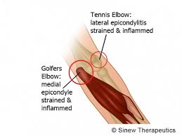 If you're experiencing regular pain when engaging in activities involving your forearm muscles, tennis elbow may be to blame. Golfers Elbow Information Sinew Therapeutics
