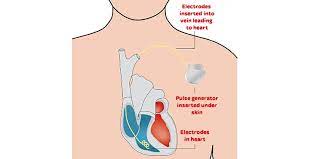 This abnormal heartbeat is called an arrhythmia. Implantable Cardioverter Defibrillator Icd Heart Foundation