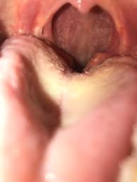 Picture of the lingual tonsil from wikimedia commons. Lingual Tonsils Can Screw You Over Too Tonsilstones