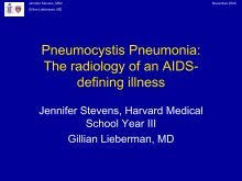 Image result for AIDS-Defining Illness
