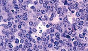 Wang hw, balakrishna jp, pittaluga s, jaffe es diagnosis of hodgkin lymphoma in the modern era // br j haematol. What S The Difference Between Hodgkin And Non Hodgkin Lymphoma