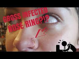 See a doctor immediately if the piercing is worsening as it can lead to scarring. 10 Tips To Treat An Infected Nose Piercing