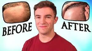 Since then fda has approved its use for hair growth. Nofap Hair Lossvlipa Lv