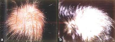Betamethasone topical is used to help relieve redness, itching, swelling, or other discomfort caused by skin conditions. Randomized Comparison Of Topical Betamethasone Valerate Foam Intralesional Triamcinolone Acetonide And Tacrolimus Ointment In Management Of Localized Alopecia Areata