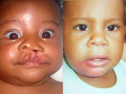 We did not find results for: Cleft Lip Surgery Cleft Palate Surgery Dr Andrew Jacono