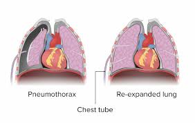 Image result for Open Pneumothorax